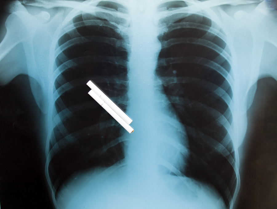 Smoking and Spine Pain