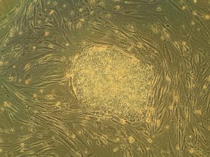 stem cell therapy