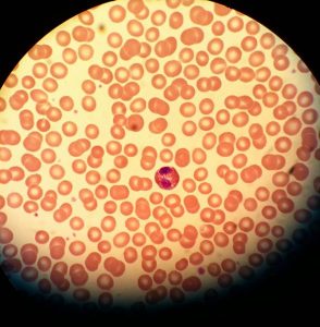 PRP Therapy